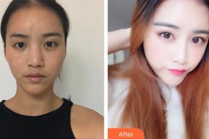 慈溪悅爾醫(yī)學(xué)美容醫(yī)院吳仁欽整形價格表附肋軟骨隆鼻案例展示