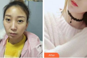 慈溪悅爾醫(yī)學(xué)美容醫(yī)院林振東整形價格表附鼻部綜合案例展示