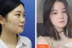 慈溪圣愛醫(yī)院整形美容科王志忠整形價格表附鼻部綜合案例展示