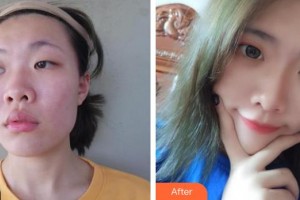 東陽麗萊醫(yī)療美容醫(yī)院姬廣翰整形價格表附鼻部綜合案例展示