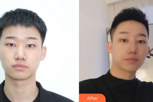 東陽麗萊醫(yī)療美容醫(yī)院鄧飛艷整形價格表附鼻部綜合案例展示