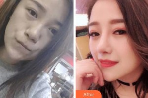 東北國際醫(yī)院整形美容再生醫(yī)學(xué)中心劉曉燕整形價格表附墊鼻基底案例展示