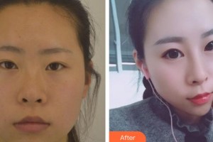 東北國際醫(yī)院整形美容再生醫(yī)學(xué)中心劉東整形價格表附鼻部綜合案例展示