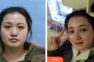 靖江三禾醫(yī)療整形美容醫(yī)院敖家順整形價格表附鼻部綜合案例展示