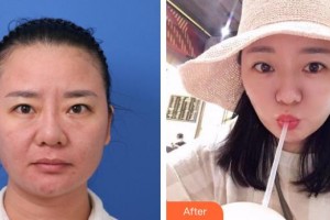 溫嶺整形美容醫(yī)院林寶婉整形價格表附埋線提升案例展示