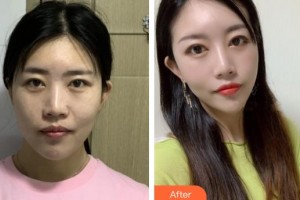 溫嶺整形美容醫(yī)院王光強(qiáng)整形價(jià)格表附熱瑪吉案例展示