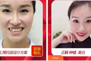 溫嶺口腔醫(yī)院葉惠挺整形價(jià)格表附隱形托槽矯正案例展示