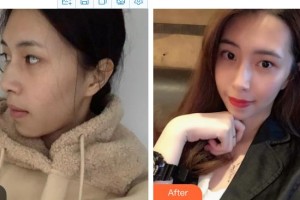 延吉金光善美容醫(yī)院金光善整形價格表附熱瑪吉案例展示