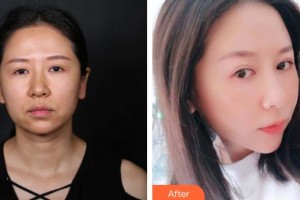 延吉趙美花保健醫(yī)學(xué)美容醫(yī)院金恩華整形價格表附埋線提升案例展示