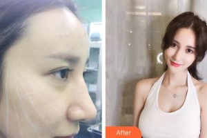 延吉王桂英醫(yī)療美容診所王桂英整形價格表附埋線提升案例展示