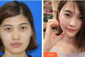延吉趙美花保健醫(yī)學(xué)美容醫(yī)院安香花整形價格表附埋線提升案例展示