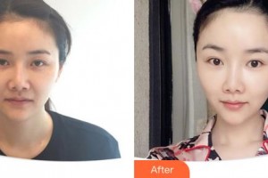 延吉董昌林醫(yī)學(xué)美容醫(yī)院董蓮花整形價格表附埋線提升案例展示