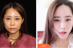 延吉趙美花保健醫(yī)學(xué)美容醫(yī)院許一整形價格表附埋線提升案例展示