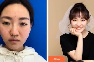 金壇伊曼醫(yī)療美容醫(yī)院夏宏飛整形價格表附埋線提升案例展示