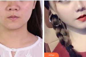 金壇伊曼醫(yī)療美容醫(yī)院晏義兵整形價格表附埋線提升案例展示