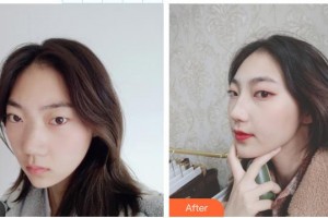 延安大學(xué)附屬醫(yī)院燒傷整形科薛宏斌整形價格表附鼻部綜合案例展示