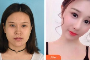 興義時(shí)光整形美容醫(yī)院劉凱整形價(jià)格表附鼻部綜合案例展示