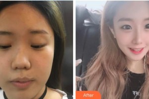 河源曙光醫(yī)療美容門診部王海龍整形價(jià)格表附隆鼻案例展示