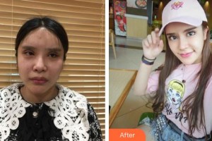 河源曙光醫(yī)療美容門診部崔軍整形價(jià)格表附鼻部綜合案例展示