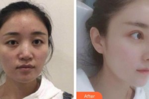 河源曙光醫(yī)療美容門診部石潤(rùn)整形價(jià)格表附假體隆鼻案例展示