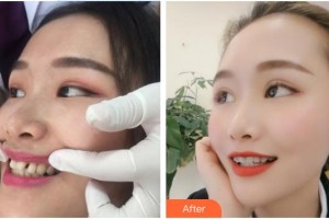 河源曙光醫(yī)療美容門診部白慧媛整形價(jià)格表附隱形托槽矯正案例展示