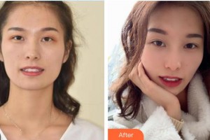 河源拜博東華口腔醫(yī)院王增全整形價(jià)格表附美白貼片案例展示