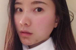 鄭州美立方醫(yī)院怎么樣？熱瑪吉2021價(jià)格分享附案例