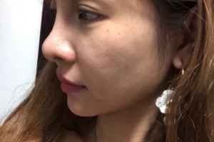 邵逸夫醫(yī)院環(huán)境怎么樣？熱瑪吉價格表和術(shù)后果