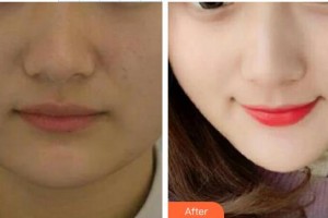 西南醫(yī)科大學(xué)附屬醫(yī)院整形燒傷外科蔣曉麗整形價(jià)格表附埋線提升案例展示