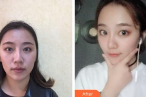 西南醫(yī)科大學(xué)附屬中醫(yī)醫(yī)院醫(yī)學(xué)美容中心杜宇整形價(jià)格表附埋線提升案例展示