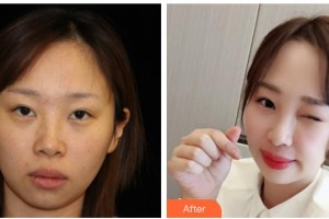 西南醫(yī)科大學(xué)附屬醫(yī)院整形燒傷外科丁曉斌整形價(jià)格表附熱瑪吉案例展示