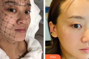 西南醫(yī)科大學(xué)附屬醫(yī)院整形燒傷外科顏洪整形價(jià)格表附熱瑪吉案例展示