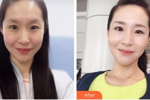 瀏陽(yáng)康美醫(yī)療美容門診部鄒笑寒整形價(jià)格表附嗨體去頸紋案例展示