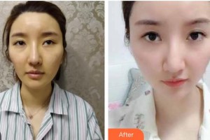 瀏陽(yáng)康美醫(yī)療美容門診部杜亞妮整形價(jià)格表除皺案例展示