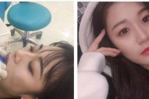 李勝凡整形價(jià)格表附金屬托槽矯正案例展示