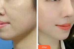 青州市人民醫(yī)院美容科張炳泰整形價(jià)格表附緊膚案例展示