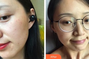 奉化市中醫(yī)醫(yī)院整形外科胡玉春整形價(jià)格表附激光美膚激光案例展示