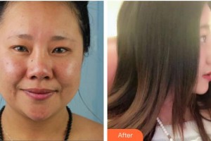 朱冠州整形價(jià)格表附鼻部綜合案例展示