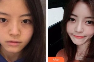 整形價(jià)格表附	項(xiàng)目分類	鼻部整形案例展示