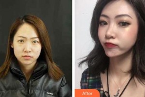 渭南市第二醫(yī)院醫(yī)療美容科向孟娟整形價(jià)格表附鼻部綜合案例展示