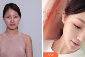 王善良整形價(jià)格表附硅膠隆鼻案例展示