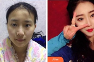 吉首希美醫(yī)療美容門診部代其超整形價(jià)格表附鼻部綜合案例展示