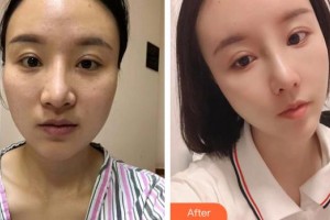 都勻利美康醫(yī)療美容門診部張會(huì)英整形價(jià)格表附耳軟骨復(fù)合隆鼻案例展示