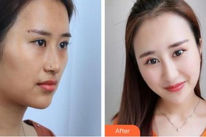 整形價(jià)格表附假體隆鼻案例展示