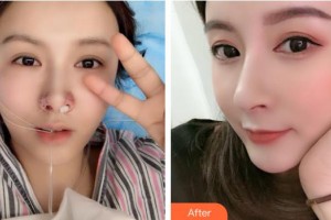 整形價(jià)格表附鼻部綜合案例展示