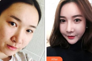 哈爾冰雙燕醫(yī)療美容門診部滕雙艷整形價(jià)格表附鼻部綜合案例展示