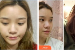 渭南海成皮膚?？漆t(yī)院韓海成整形價(jià)格表附熱拉提案例展示