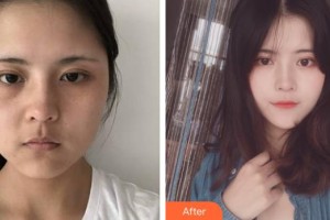 茂名華美整形美容醫(yī)院劉會(huì)良整形價(jià)格表附埋線提升案例展示