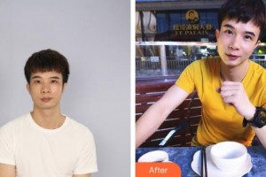 李賢擇整形價(jià)格表附埋線提升案例展示