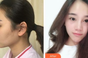 侯馬晨暉醫(yī)學(xué)美容門診部李晉才整形價(jià)格表附埋線提升案例展示